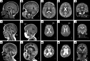 Read more about the article پاورپوینت آماده در مورد روش تصویربرداری MRI از سر و گردن