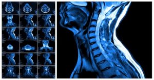 Read more about the article پاورپوینت آماده در مورد روش تصویربرداری MRI از فقرات