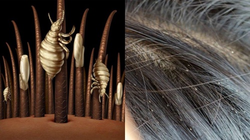 You are currently viewing تحقیق درباره شپش موی سر و راه های درمان آن