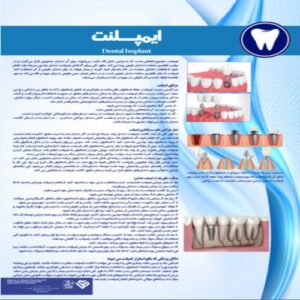 Read more about the article پوستر ایمپلنت دندان – مجموعه پوسترهای دندانپزشکی