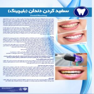 Read more about the article پوستر سفید کردن دندان بلیچینگ – مجموعه پوسترهای دندانپزشکی