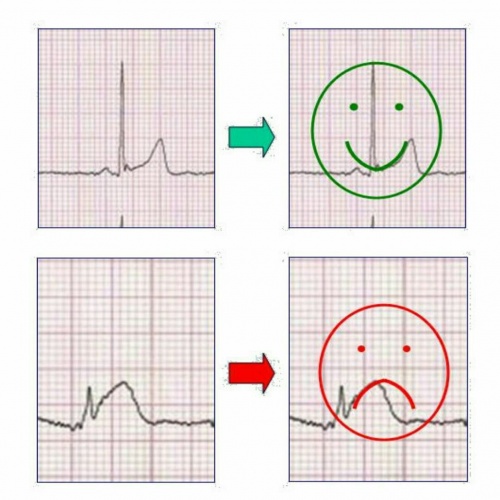 You are currently viewing تفسیر کامل ECG