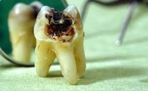 Read more about the article پاورپوینت تدریس و کنفرانس DENTAL CARIES (پوسیدگی دندان)