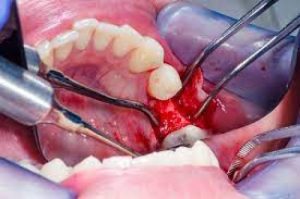 Read more about the article پاورپوینت آماده کنفرانس تکنیک جراحی لثه(Gingival Surgical Technique)